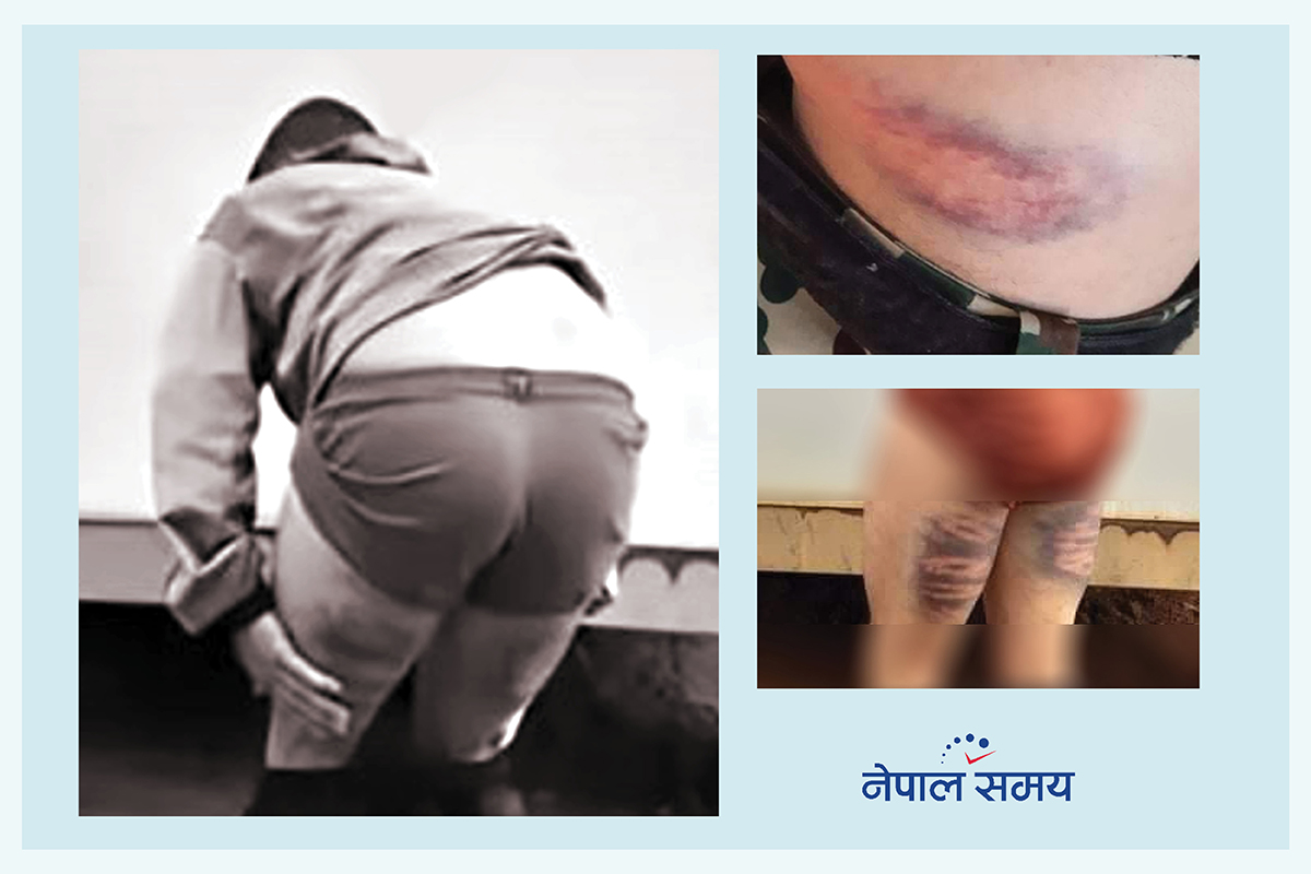 कंगोमा कुटाइ खाएका नमराजको बयानः सेनाका क्याप्टेनहरूले मलाई फुटबल बनाएर हाने